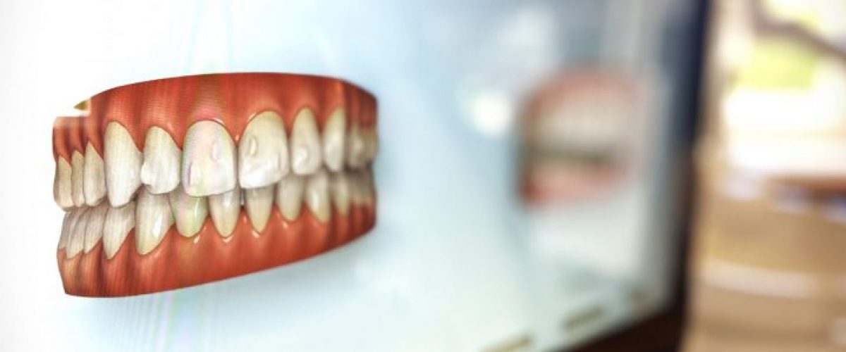 Feste Zahnspange aus Spandau: Die optimale Tragezeit für Aligner​
